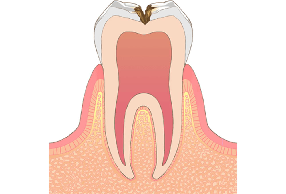 象牙質の虫歯
