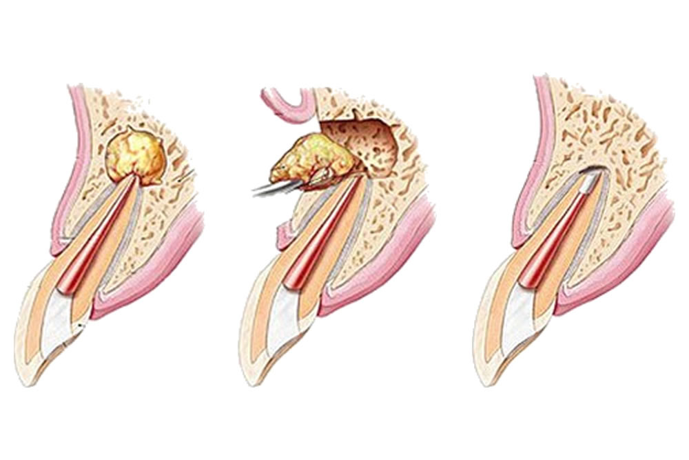 歯根端切除（外科的歯内療法）の実施