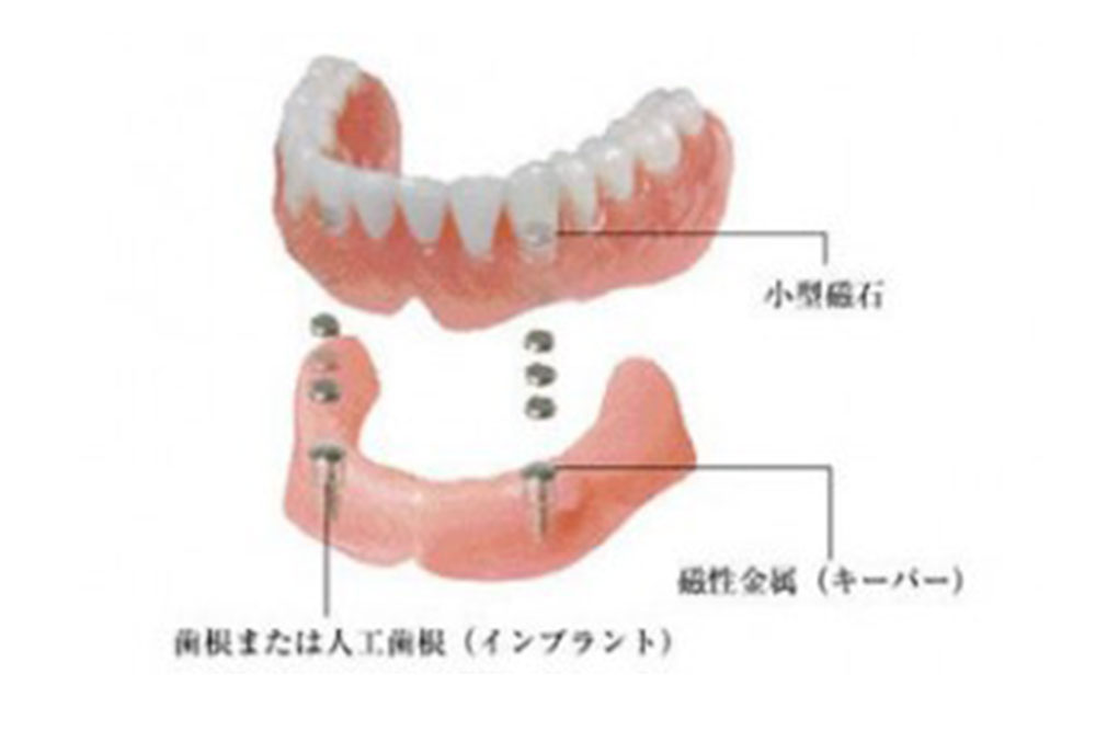 金属床デンチャー