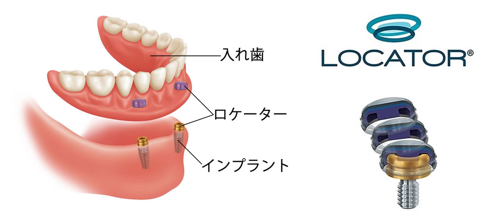 ロケーター義歯