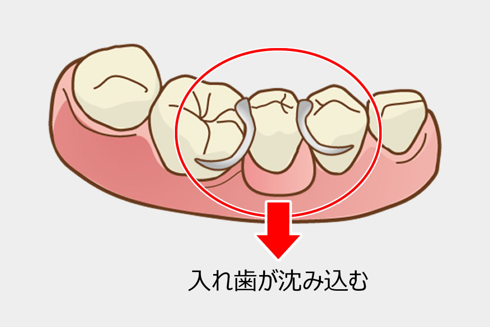 入れ歯が合わない理由