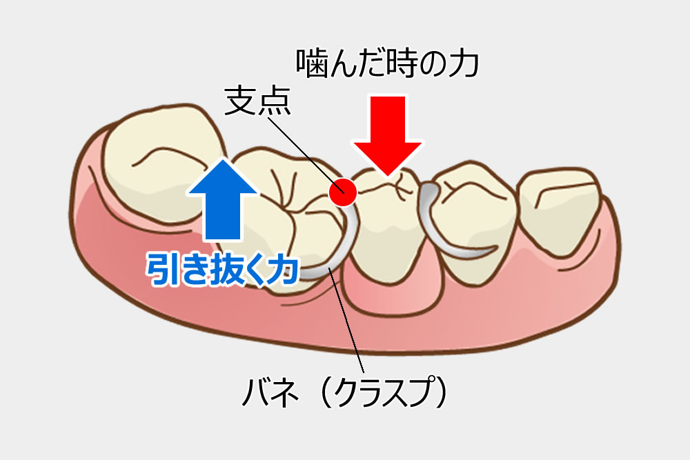 よく噛める・ズレない精密な入れ歯｜座間市の入谷歯科