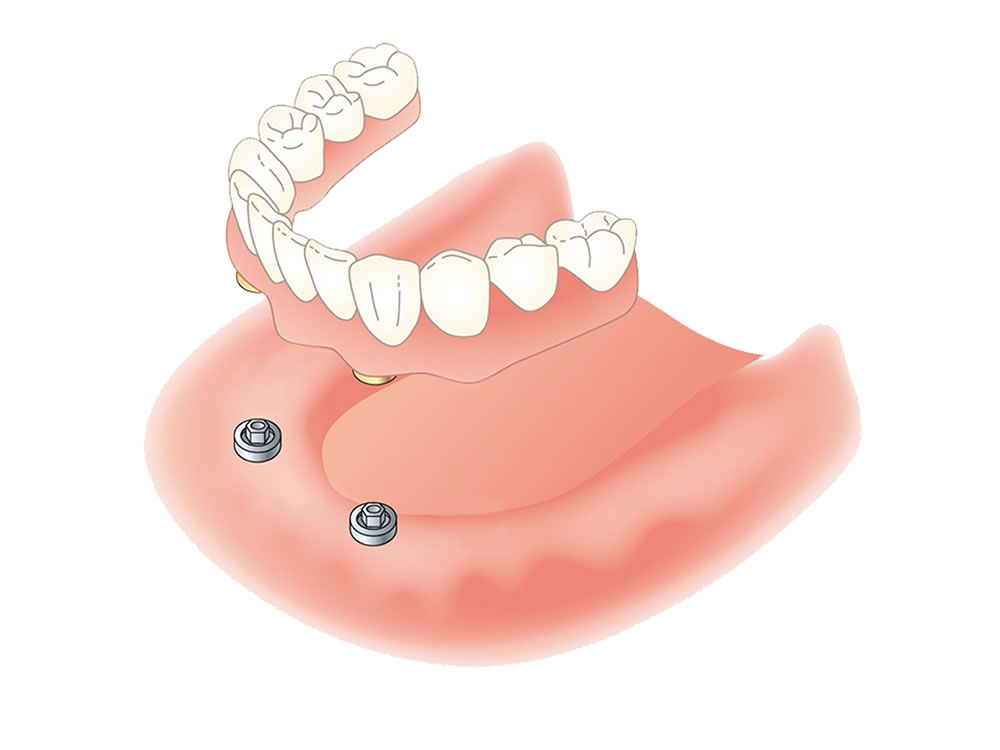 インプラントオーバーデンチャー