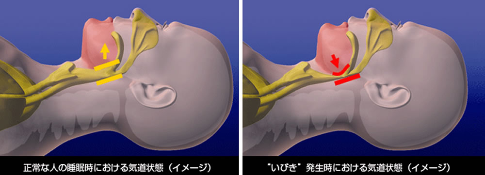 原因に合わせた口腔内装置を作製