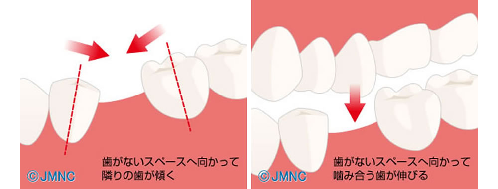 咬み合わせの不具合による体への影響