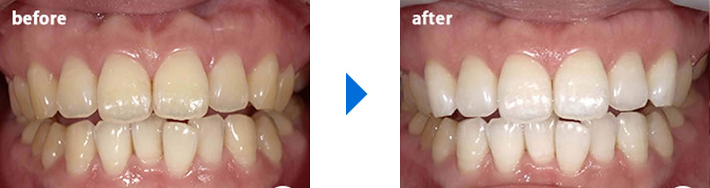 ホワイトニング症例