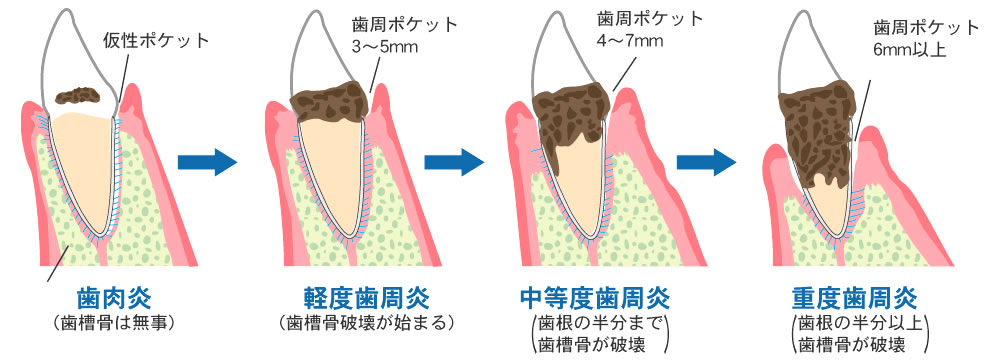 歯周病の発生要因及び進行度